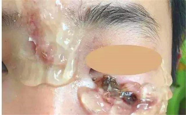 2岁孩子脸部被划伤，妈妈拿芦荟胶当“万能胶”，差点让孩子毁容