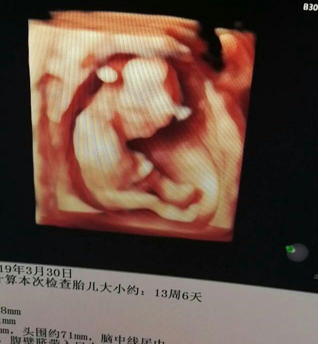 怀孕各个时期，如何通过B超看胎儿的大小？准妈妈需要注意这3点