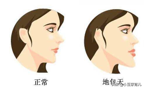 喝奶姿势不对，我的孩子成了“嬷嬷嘴”