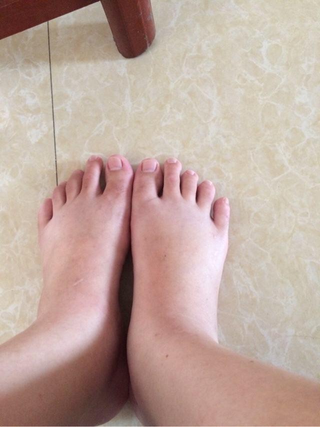 孕期脚肿有可能是这个危险的原因造成的，孕妈早知道早预防