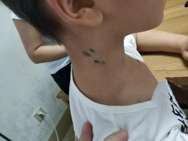 10岁男孩脖子上满是针眼，竟然是父母&quot;雇人&quot;扎的，原因闻所未闻