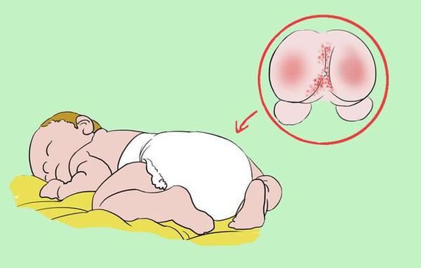 ?夏天炎热，宝宝的红屁股“成灾”？医生：这4种方法可缓解