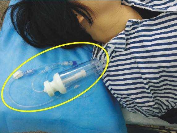 产妇剖腹产后用镇痛泵有必要吗？医生坦白真相，网友：不是忽悠？