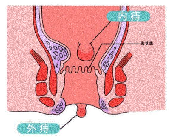 产后痔疮疼还是分娩疼？宝妈：一波未平又起一波，各有各的疼法