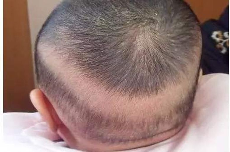 辟谣：宝宝枕秃是缺钙？怀疑佝偻病？营养师：3个方法判断和预防