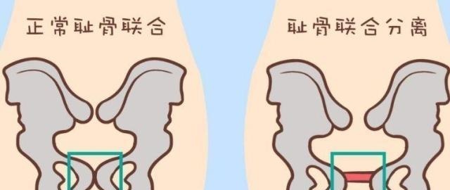 生过孩子的女人，盆骨都会被打开吗？打开的盆骨不恢复有啥危害？