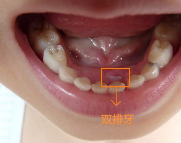 在换牙期，别给孩子这样吃饭，容易长出“双排牙”，家长要留心