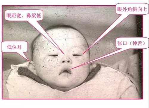 每20分钟就有一个“唐氏儿”出生，医生：这类孕妈占比例最高