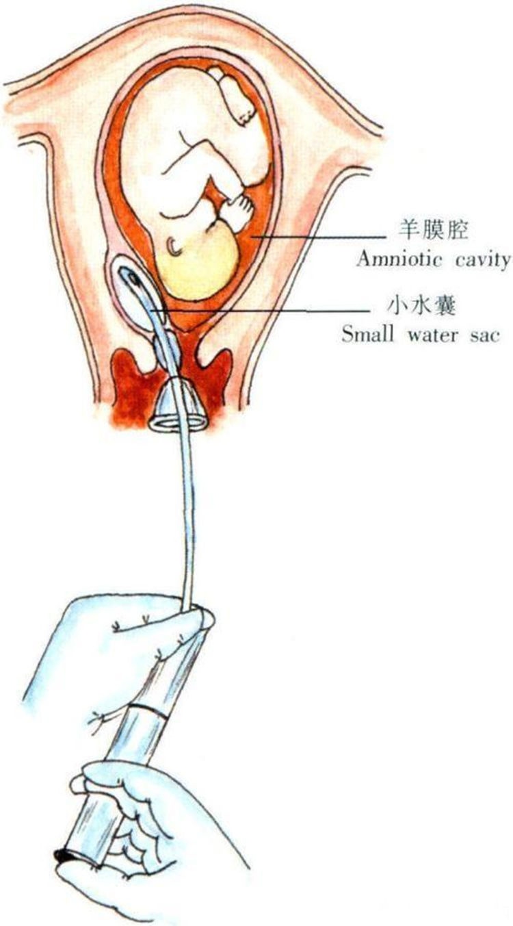 怀孕40周+1，羊水37㎜，医生：通常需要催产