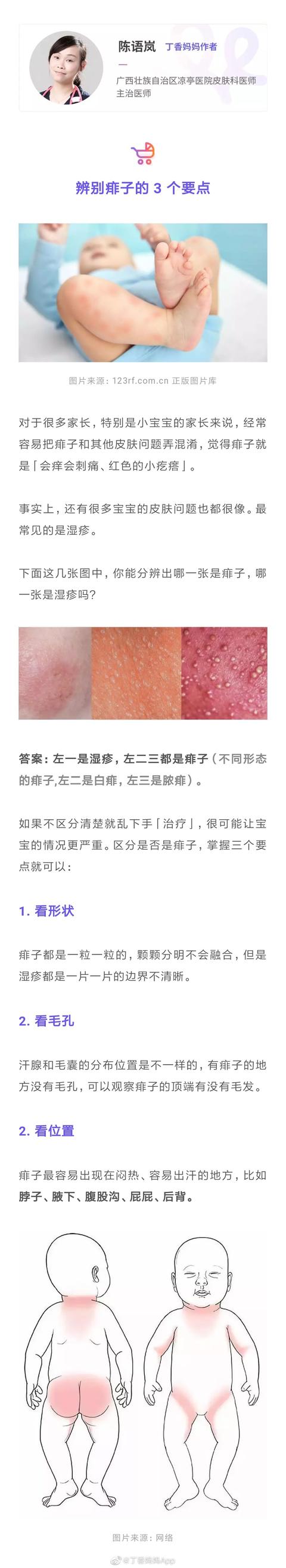 记住「不要捂」，不用痱子粉和花露水，痱子不再是烦恼