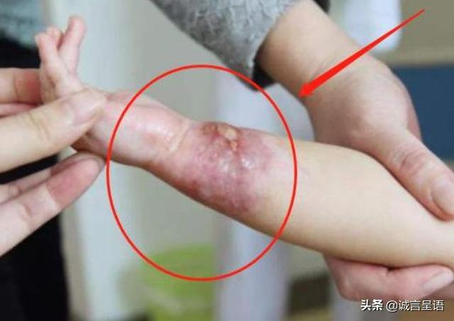 孩子烫伤后的2分钟内，是最佳治疗时间，这种补救措施家长要知道