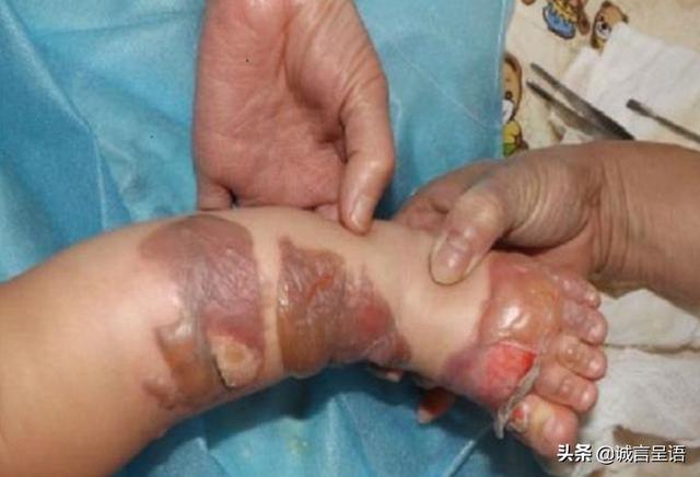 孩子烫伤后的2分钟内，是最佳治疗时间，这种补救措施家长要知道