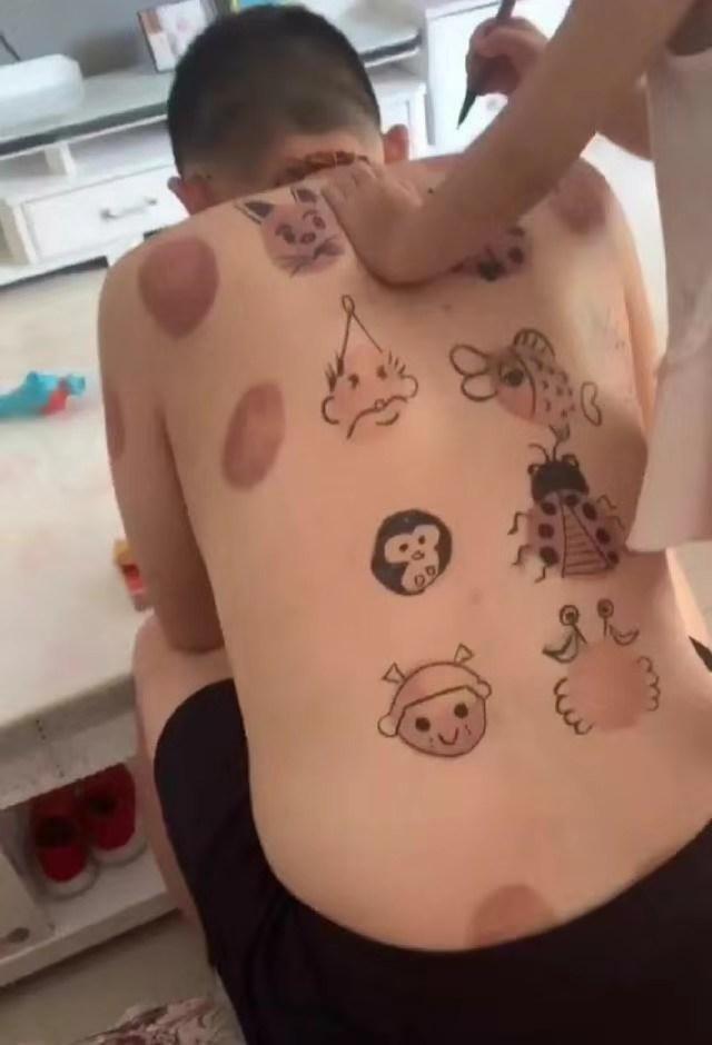 爸爸拔完火罐的正确方式：让孩子在上面画画