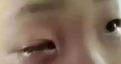 3岁男童误把石灰撒眼，妈妈的错误做法，让儿子眼睛灼伤医生惋叹
