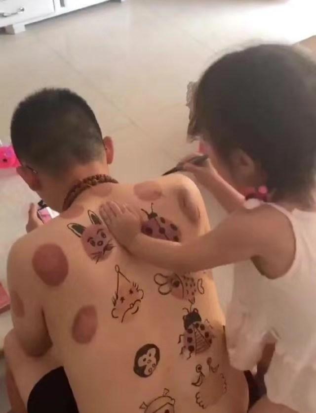 爸爸拔完火罐的正确方式：让孩子在上面画画