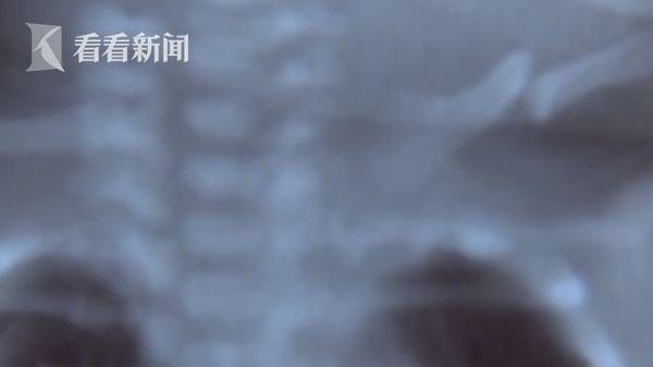 看社会｜出生3个月后家属才知孩子骨折：医院隐瞒病情