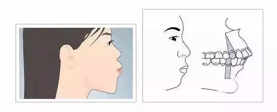 12岁前必须处理的12种儿童牙颌畸形