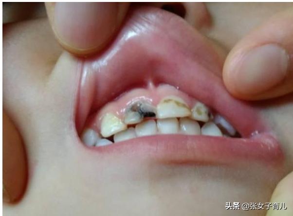 1岁宝宝一口烂牙，可能都是因为父母的这3个坏习惯，别不在意