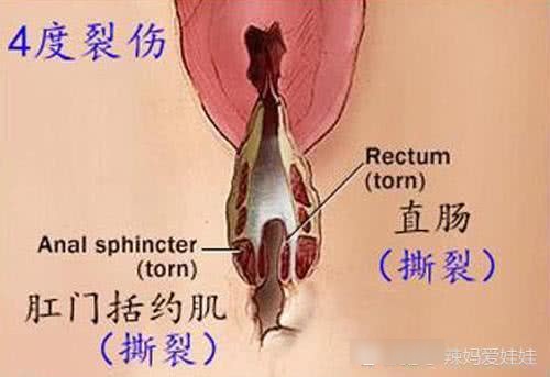 顺产撕裂恢复图：顺产生宝宝，也不简单，产妇不容易