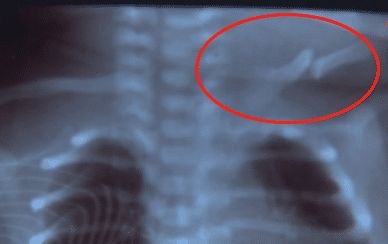 宝宝出生时锁骨骨折，接生医生却隐瞒病情，医生:这很正常
