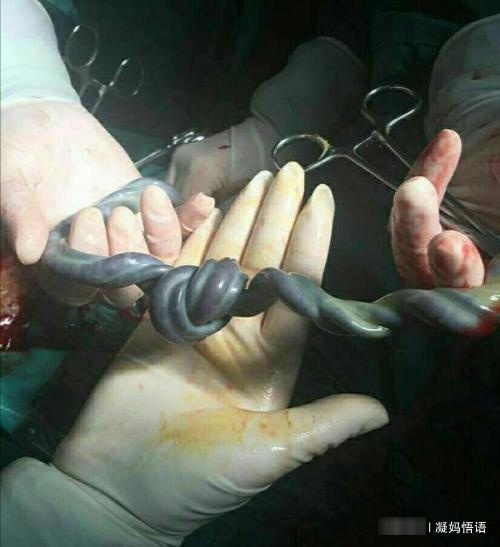 孕妈妈没注意这些事项，胎儿“喘不动气”，孕妈早准备早安心