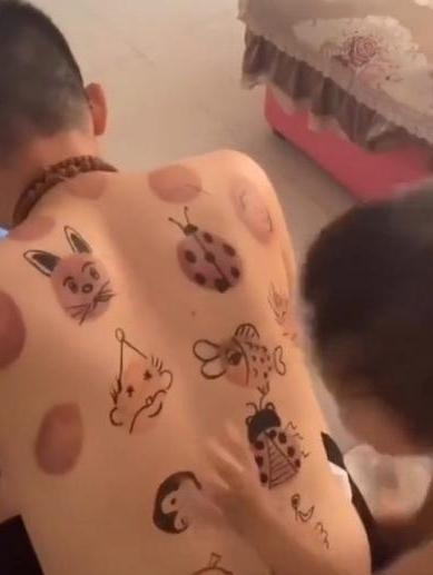 女儿的作品“拔罐后的爸爸”，当镜头转向爸爸，妈妈忍不住笑出声