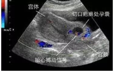 快临产的产妇，肚子突然塌陷，要命的缩复环，紧急的剖腹产