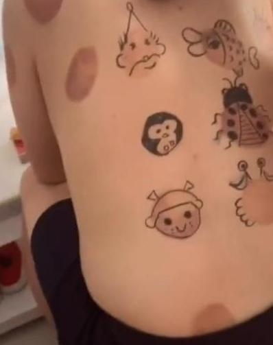 女儿的作品“拔罐后的爸爸”，当镜头转向爸爸，妈妈忍不住笑出声