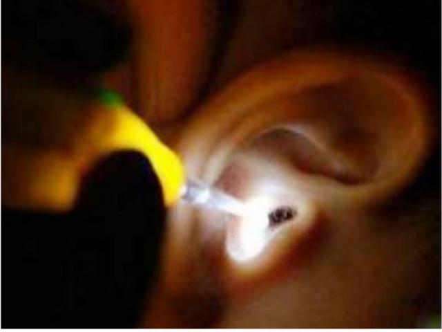 8岁女童总吵着耳朵痒，爸爸拿手电一照，瞬间倒吸一口凉气
