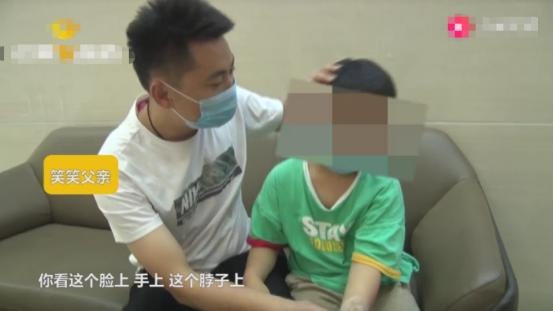 心疼！8岁男童不吃早饭上学，全身蔓延性白斑，只为了多睡几分钟