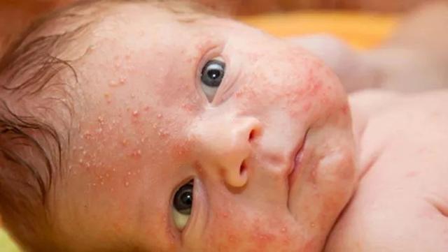 来势汹汹的纸老虎：幼儿急疹