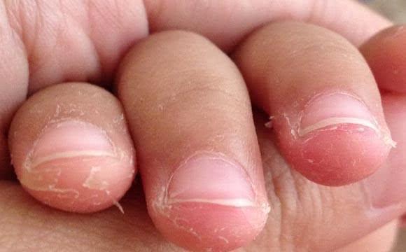 宝宝手上经常长倒刺，可能和这2点有关，妈妈别忽视了