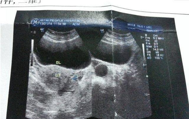 49岁高龄孕妈已确诊怀孕，一周后突然流产，医生：已告诫