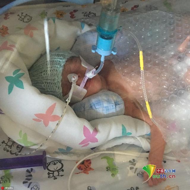 出生时只有妈妈手掌大的双胞胎健康长大