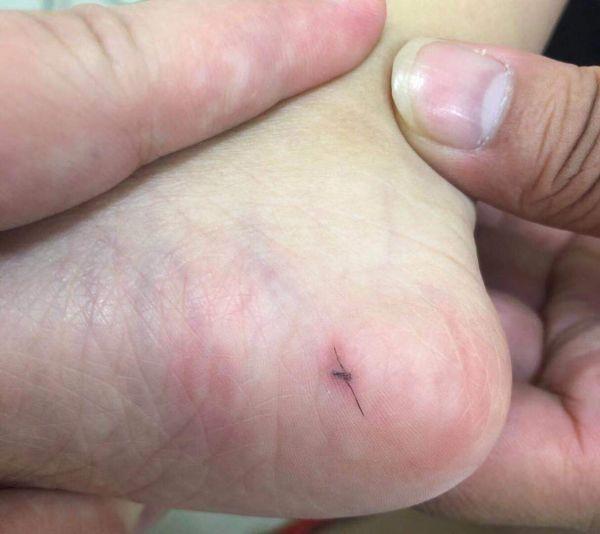 小宝宝脚底突现“黑虫”，还会变形！取出一看竟是……