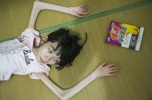 15岁女孩体重只有40斤，饿也不能吃饭，得知真相，大家泪目