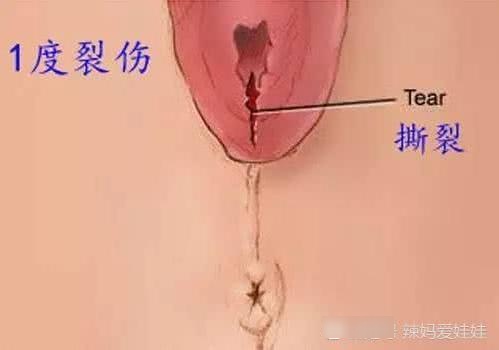 侧切与撕裂，哪个伤害更大？看图就知道，产妇不容易