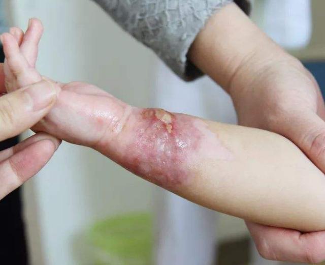 宝宝被烫伤奶奶抹大酱？2分钟的黄金时间，你知道该怎么做吗