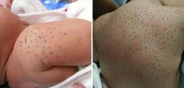新生儿身上长满“黑刺”，宝妈听信婆婆的话全拔掉，差点酿成大祸