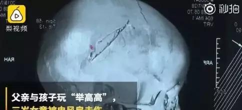 家长请注意！父女俩玩举高高，3岁女童被吊扇削到头致骨折