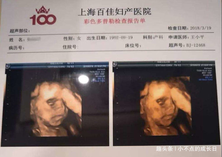 孕期产检做四维彩超时，为什么胎儿总是会捂着脸？