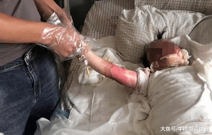 女童跌进炸油锅！父母帮脱衣却撕下整片皮，妈妈事后懊恼太心急
