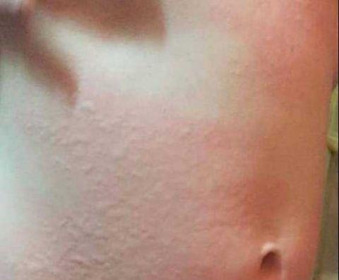 英国3岁小女孩免疫失调，甚至冰淇淋也不能吃，太阳不能晒