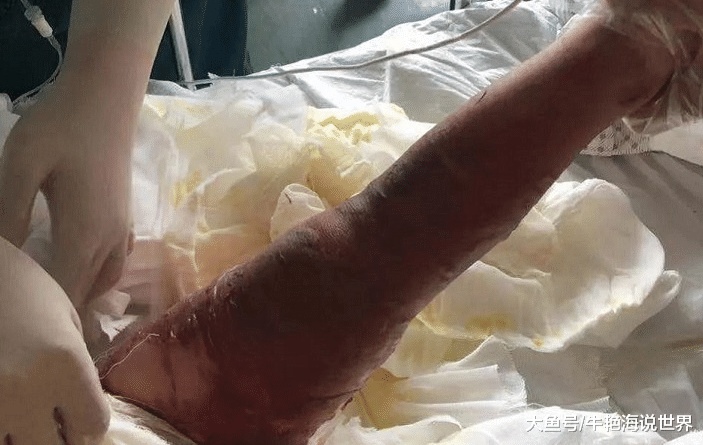 女童跌进炸油锅！父母帮脱衣却撕下整片皮，妈妈事后懊恼太心急