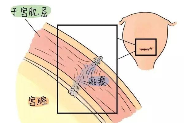 生完孩子还会有宫缩，二胎妈妈产后宫缩痛会更厉害，这是为什么？