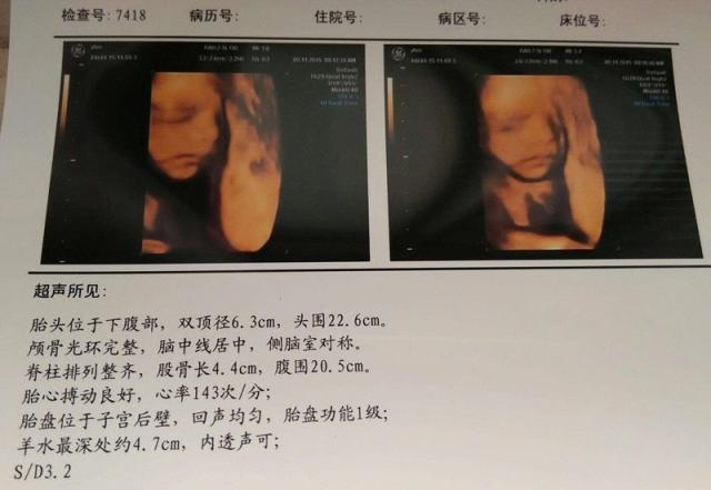 胎宝宝在妈妈肚子尽干“坏事”？四维还没做完，就逗乐了一众医生