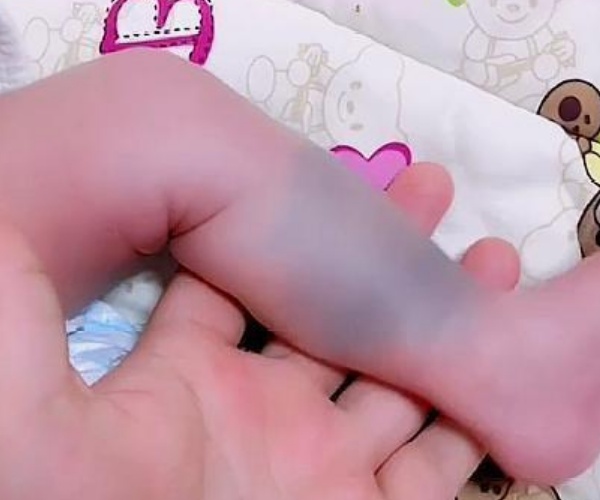 育儿：准妈妈这三种行为，最容易让胎记找上宝宝，尽量注意避免！