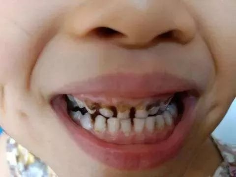 孩子小小年纪就有色素牙，到底是怎么回事？家长要重视吗？