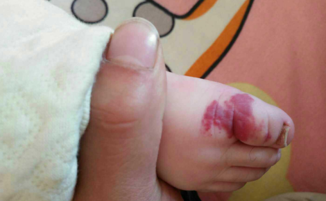 宝宝患血管瘤被当“胎记”，会引发这3种问题，早知道宝宝少遭罪