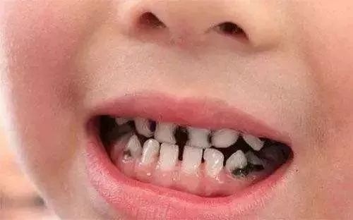 孩子小小年纪就有色素牙，到底是怎么回事？家长要重视吗？
